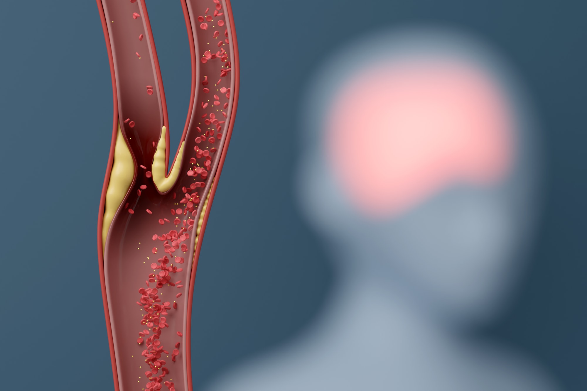 Carotid artery at Complete Vascular Care