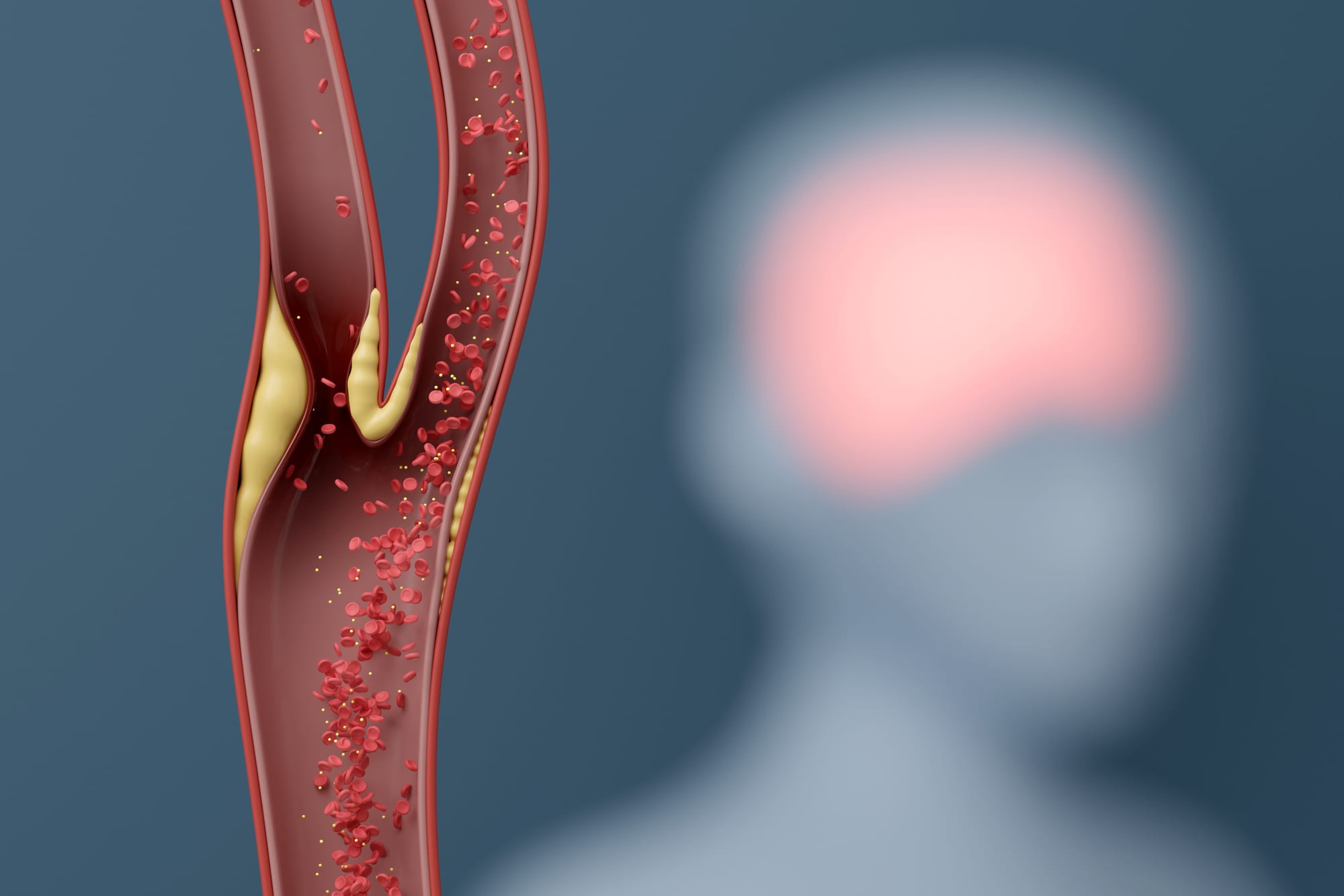 3D illustration of a carotid artery narrowed by plaque where it branches, with the brain highlighted in the background