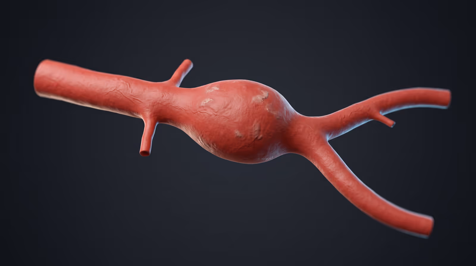 Anatomical model of the abdominal aorta showing a bulging aneurysm above the iliac branches