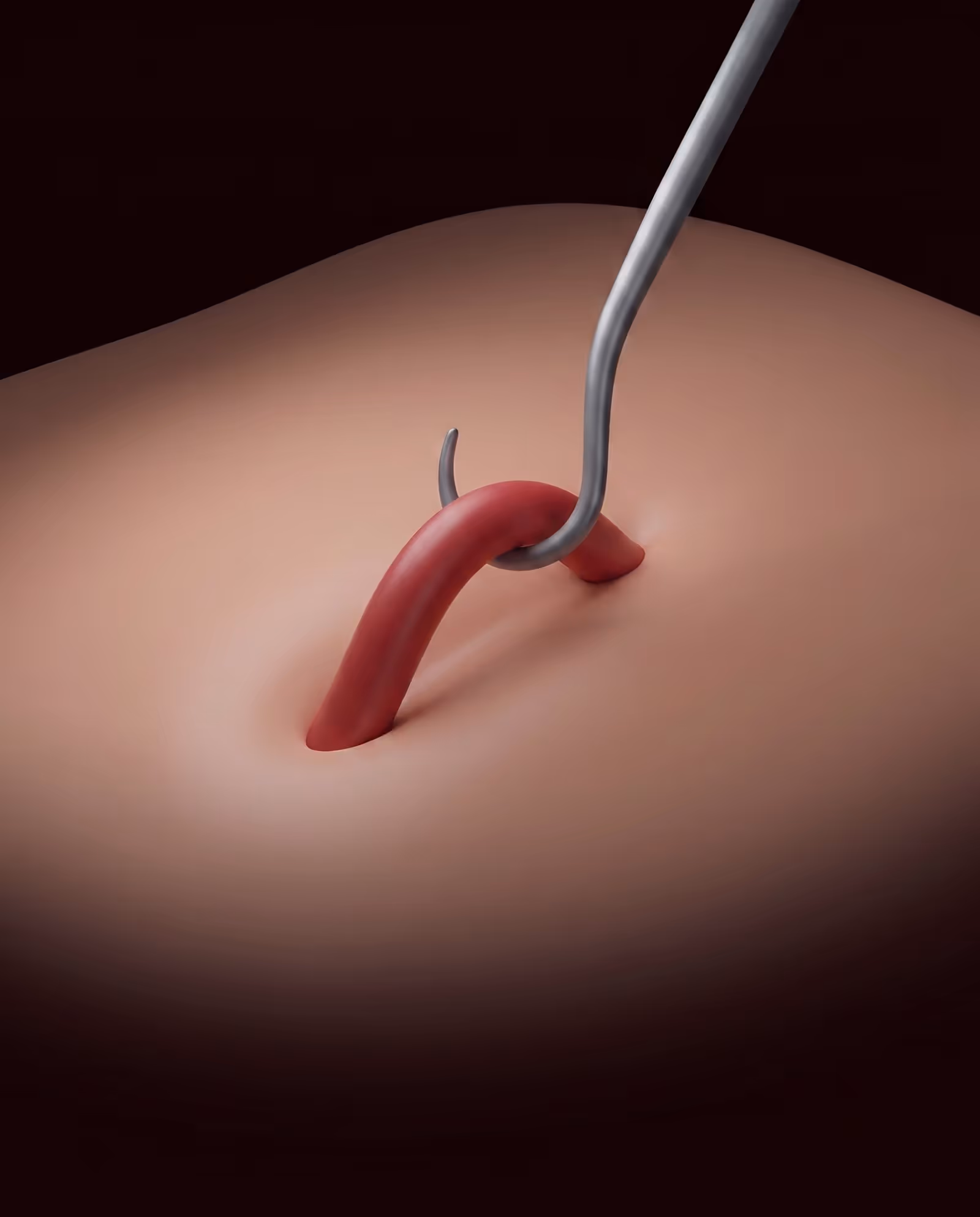 Medical illustration showing a surgical hook being used to remove a varicose vein through a small skin incision during a stab phlebectomy.