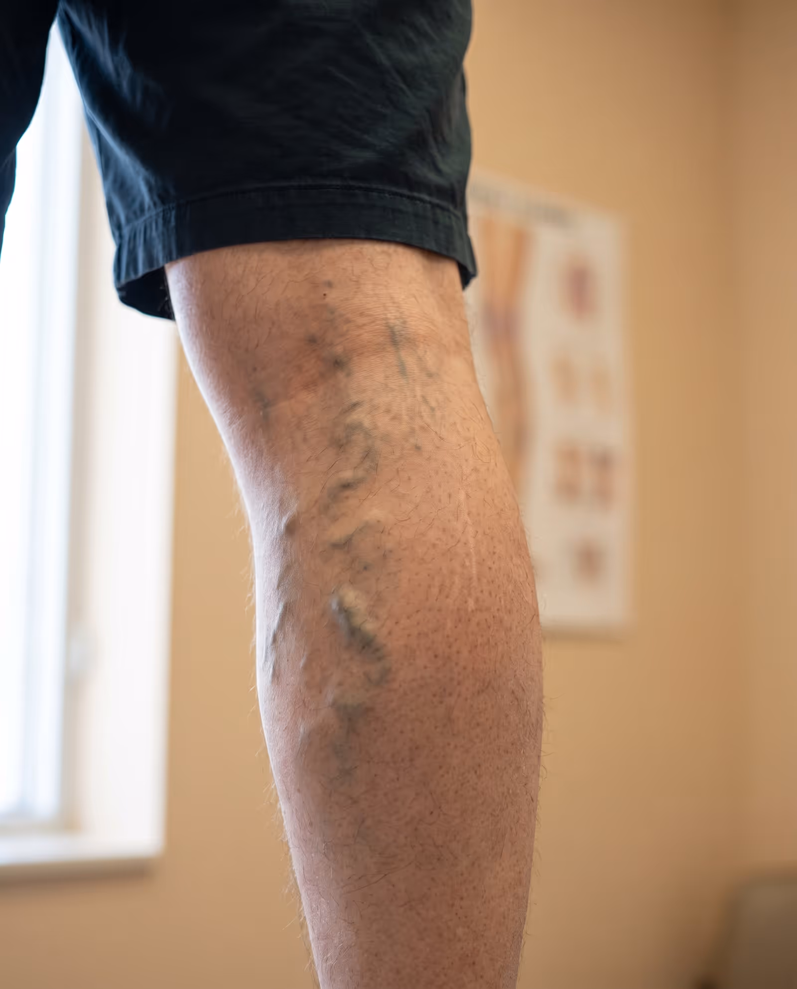 aricose veins on a person's calf while standing