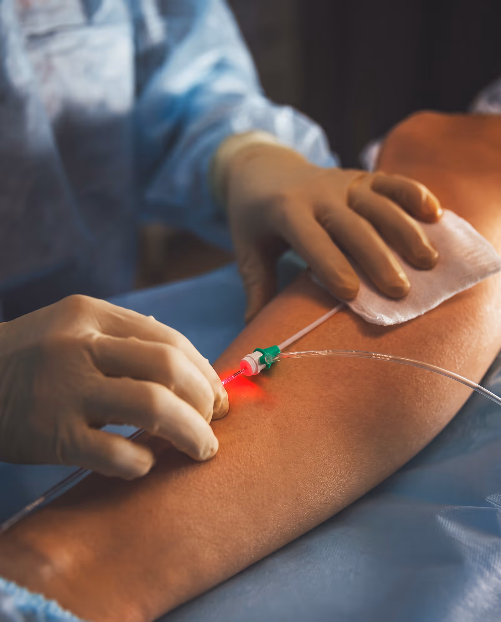 Medical procedure showing a catheter inserted into a leg during venous ablation treatment for varicose veins.