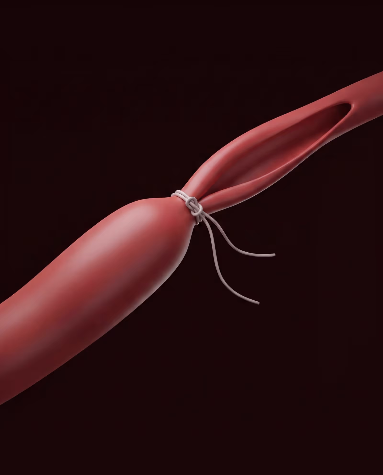 Medical illustration showing a vein being tied off with a surgical suture during venous ligation.