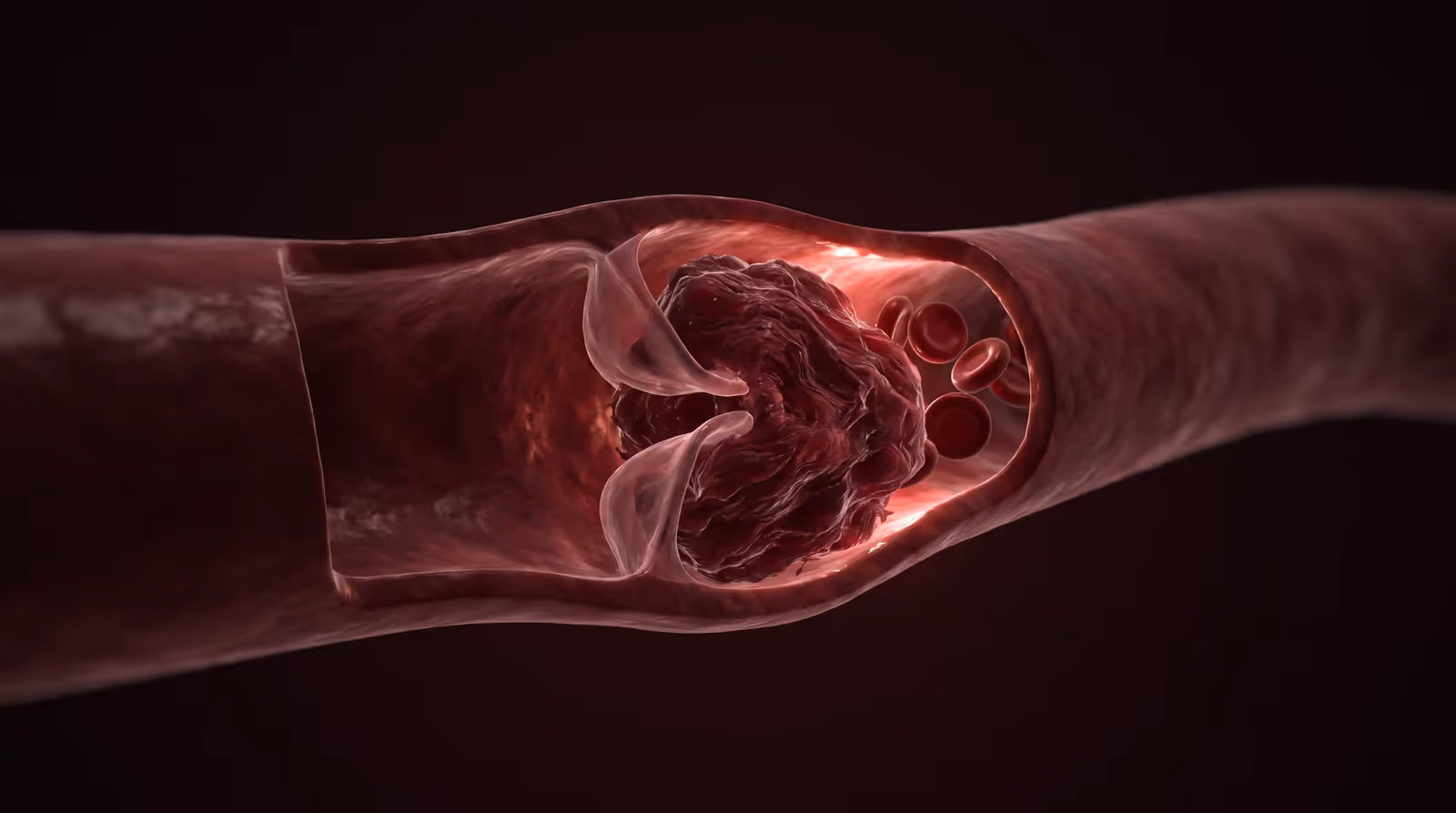 Cross-section illustration of a deep leg vein with a blood clot lodged against the valve, blocking the channel
