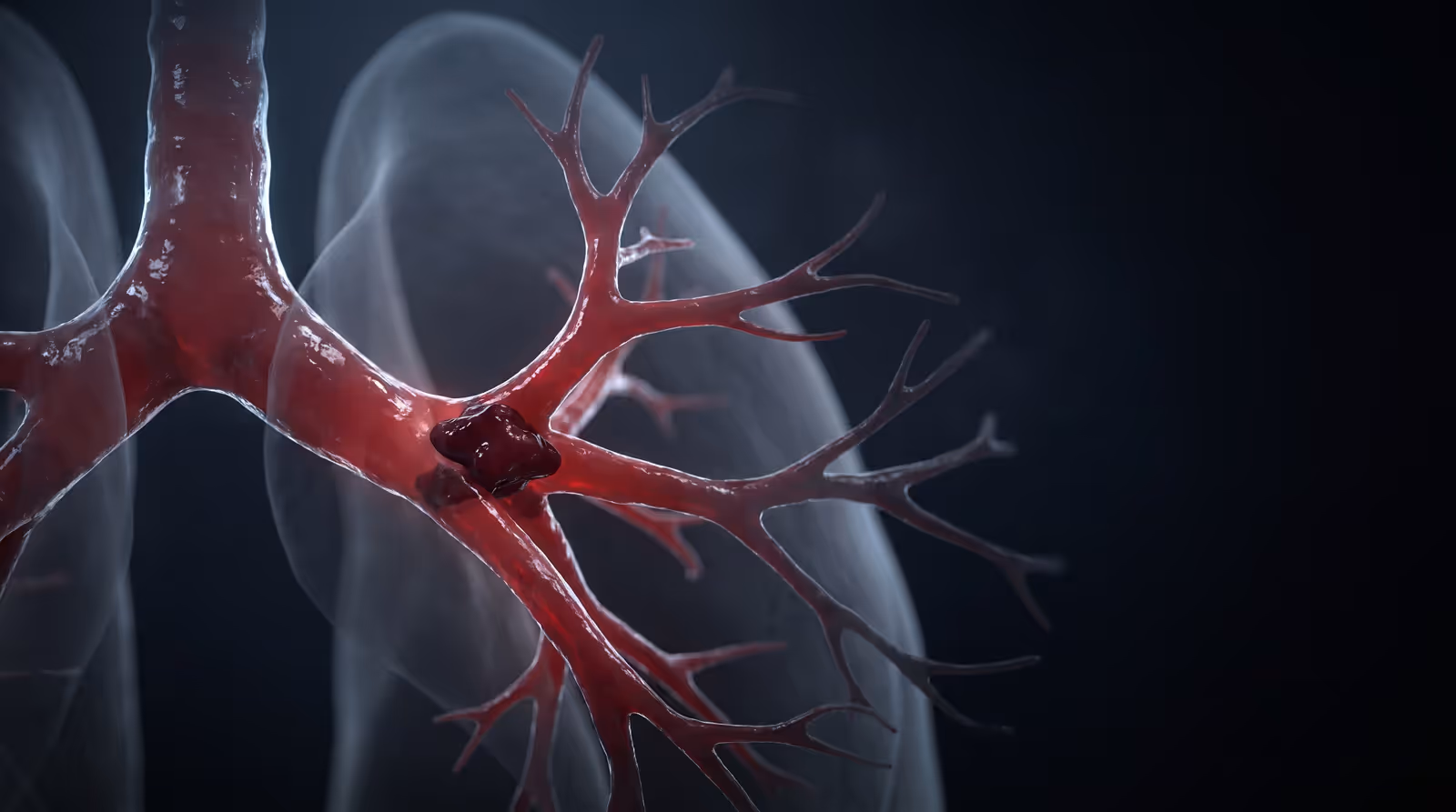 Illustration of the pulmonary artery tree with a clot wedged at a branch point inside the lung